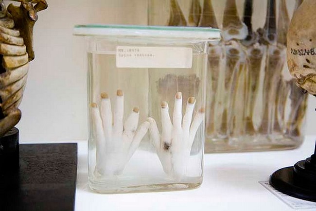 Экспонаты музея патолагоанатомии в Башне сумасшедших, Вена