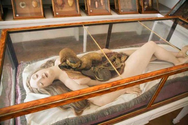 Экспонаты музея патолагоанатомии в Башне сумасшедших, Вена